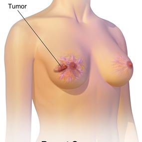 سرطان الثدي قد يعود بعد 15 عاما من انتهاء العلاج